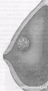 Фото схема проявления ВПЧ на груди 