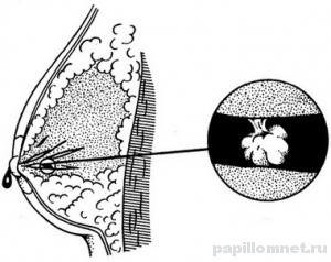 Фото схема образования папилломы на соске