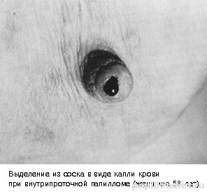 Фото проявления при заболевании внутрипотоковой папилломы