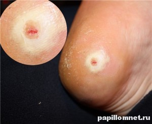 Фото сухой мозоли