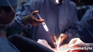 Изображение процедуры удаления кондиломы электрокоагуляицей