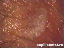 Фото кондилом у беременной девушки