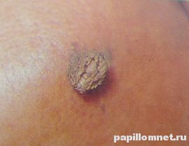 Изображение широкой кондиломы
