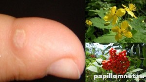 Фото бородавки на пальце, которую можно удалить народными средствами