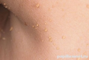 Множественные образования бородавок на шее у человека