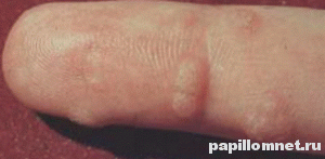 Изображение старческой бородавки 