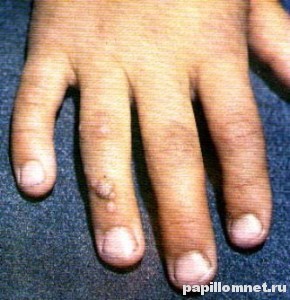 Фото вульгарных бородавок на пальце руки