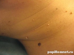 Фото подмышки человека с новообразованиями в виде папиллом