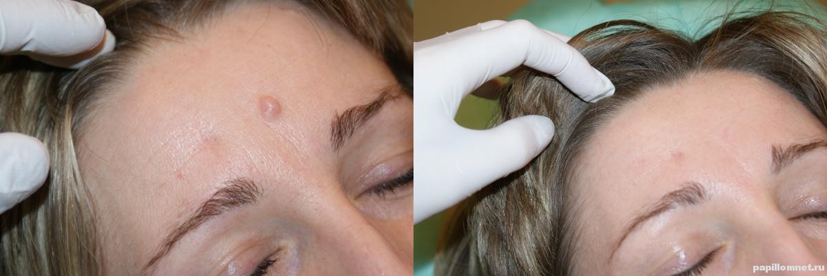 Фото лица после удаления папиллом криодеструкцией