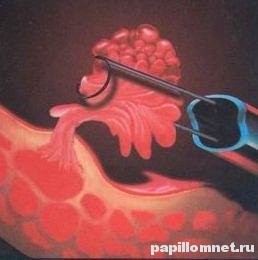 Фото процесса удаления папилломы мочевого пузыря