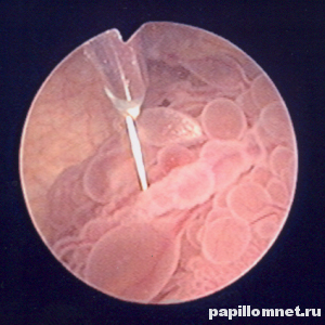 Фото папилломы мочевого пузыря