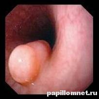 Фото папилломы пищевода