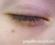 Фото папилломы у ребенка на веке