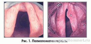Фото горла здорового человека, и горла с папилломами