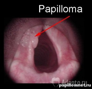 Фото папилломатоза гортани у детей