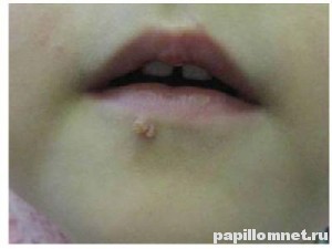 Фото папилломы у ребенка на губе