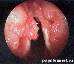 Фото гортани человека, пораженной папилломами