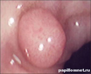 Фото полипа в ухе