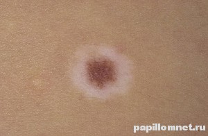 Фото невуса Сеттона на коже