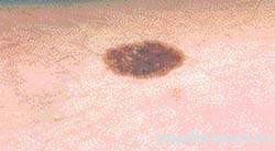 Проявления невуса на коже человека