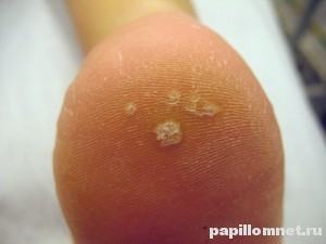 Фото куриной жопы (подошвенной бородавки) на пятке