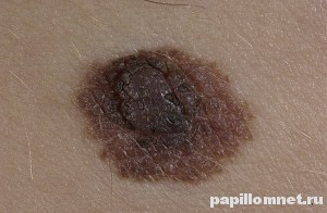 Фото меланоформного невуса