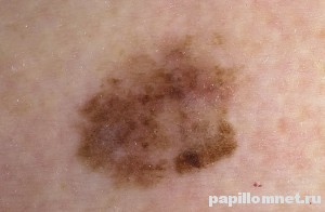 Фото меланомы кожи
