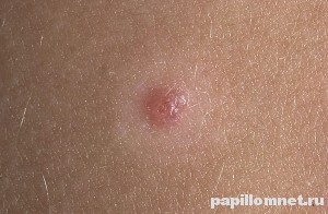 Проявление невуса Сетона на коже человека