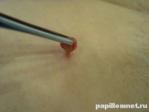 Фото папилломы на коже человека