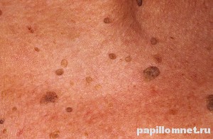 Фото папилломатоза на коже