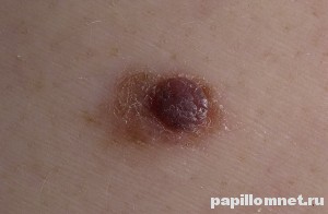 Фото дисплатического невуса на коже