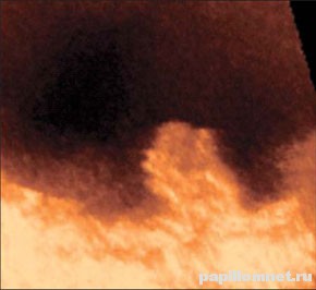 Фото полипа в мочевом пузыре Фото полипа в мочевом пузыре