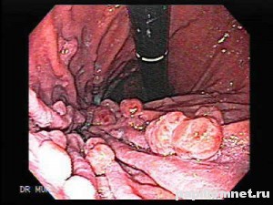 Фото полипа пищевода