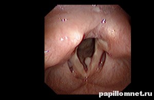 Фото полипов в горле