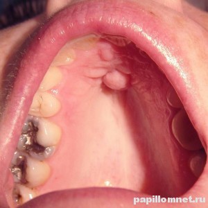 Фото полипов во рту