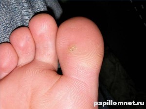 Фото шипицы на ноге, на большом пальце