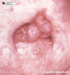 Фото полипа в матке, который был удален лазером Фото полипа в матке, который был удален лазером