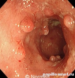 Фото полипов в прямой кишке Фото полипов в прямой кишке