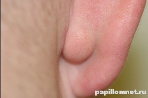 Фото атеромы за ухом