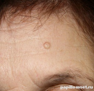 Фото атеромы на лбу