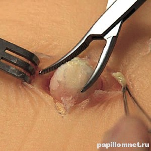 Фото удаления атеромы