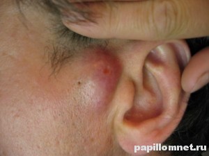 Фото атеромы на коже лица