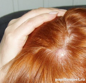 Фото атеромы волосистой части головы