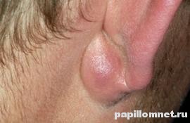 Фото атеромы на коже ушной мочки