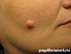 Фото атеромы на лице