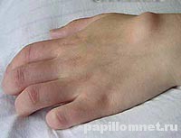 Фото атеромы на руке
