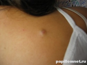 Фото небольшой атеромы на спине человека