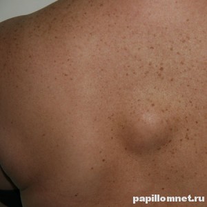 Фото атеромы на спине