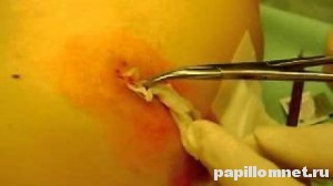 Фото операции на атерому