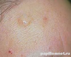 Атерома на лице человека, в начальной стадии